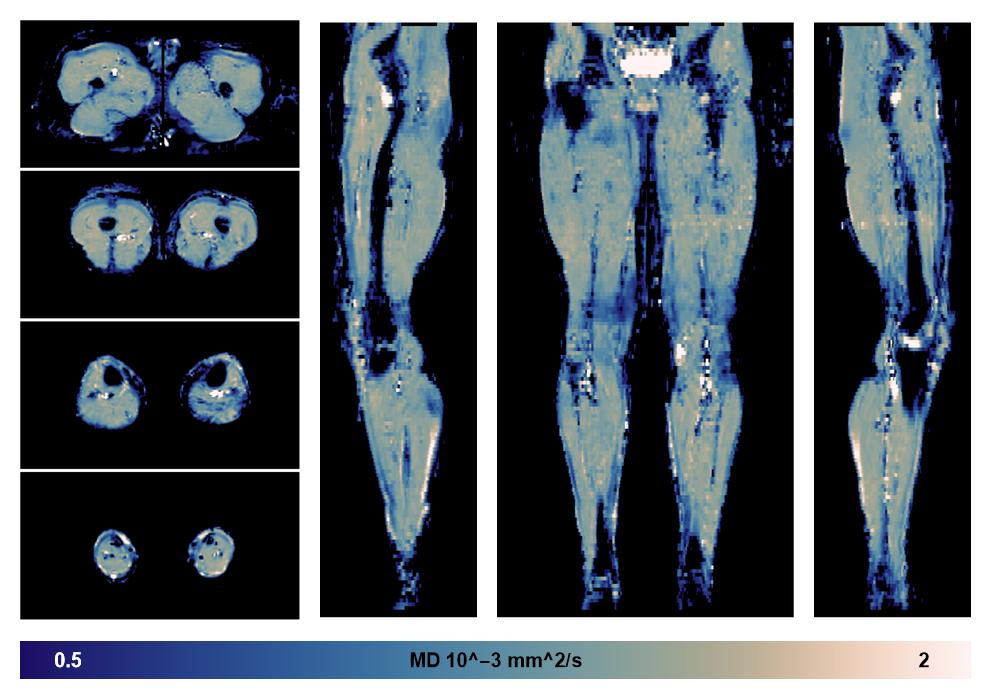 IVIM corrected whole leg muscle mean diffusivity obtained from diffusion tensor imaging.